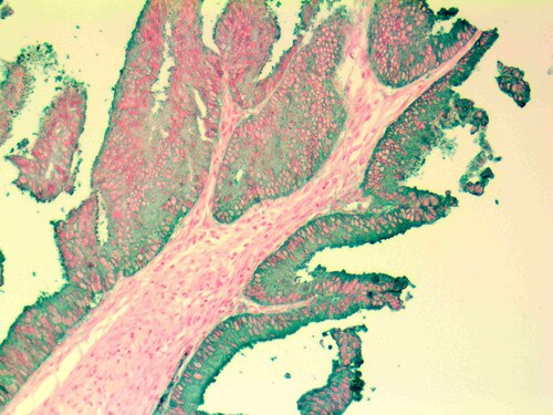 IHC of CEA BSB-13 on an FFPE Colon Adenocarcinoma Tissue